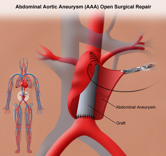 Diagram of open surgical repair of an abdominal aortic aneurysm, with a graft sewn into the aorta