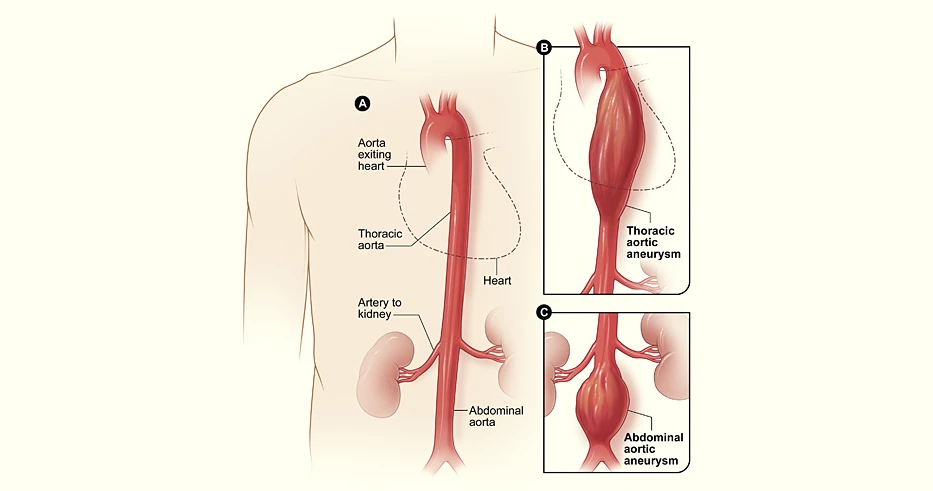 Diagram comparing a normal aorta with a thoracic aortic aneurysm and an abdominal aortic aneurysm