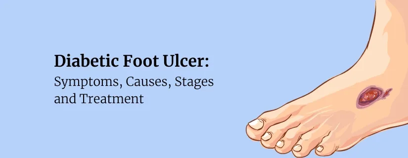 Illustration of an ulcer on the sole of a diabetic foot, beside the article title on causes and stages
