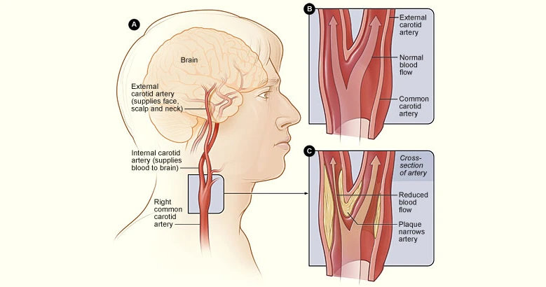 Diagram of the carotid artery in the neck, with a normal cross-section and one narrowed by plaque