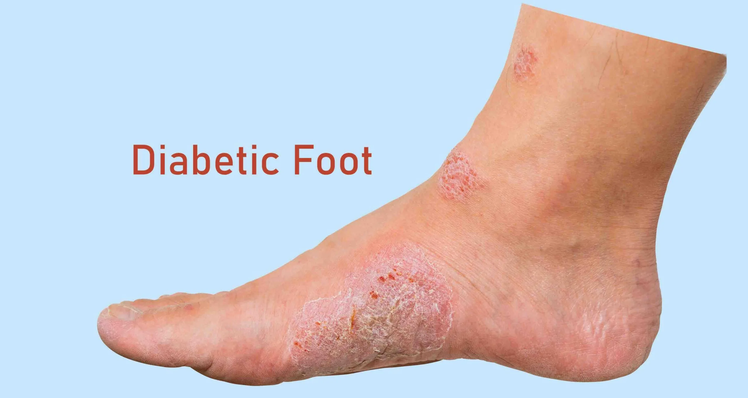 Side view of a diabetic foot with ulceration and skin breakdown around the heel and ankle