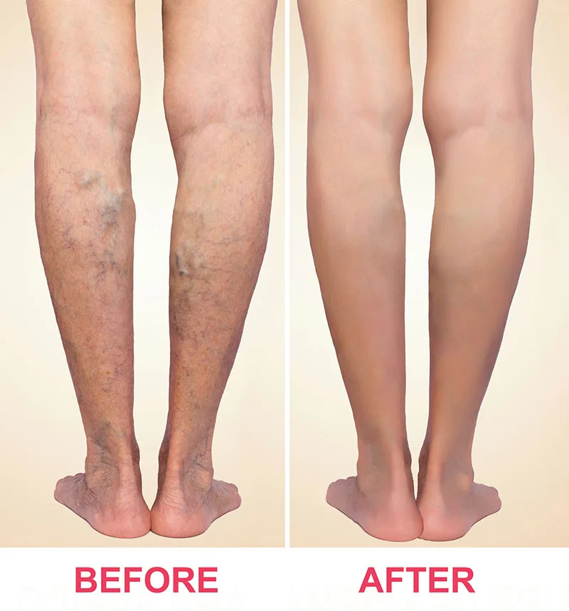 Before and after endovenous laser treatment, showing prominent varicose veins on the lower legs then clear skin