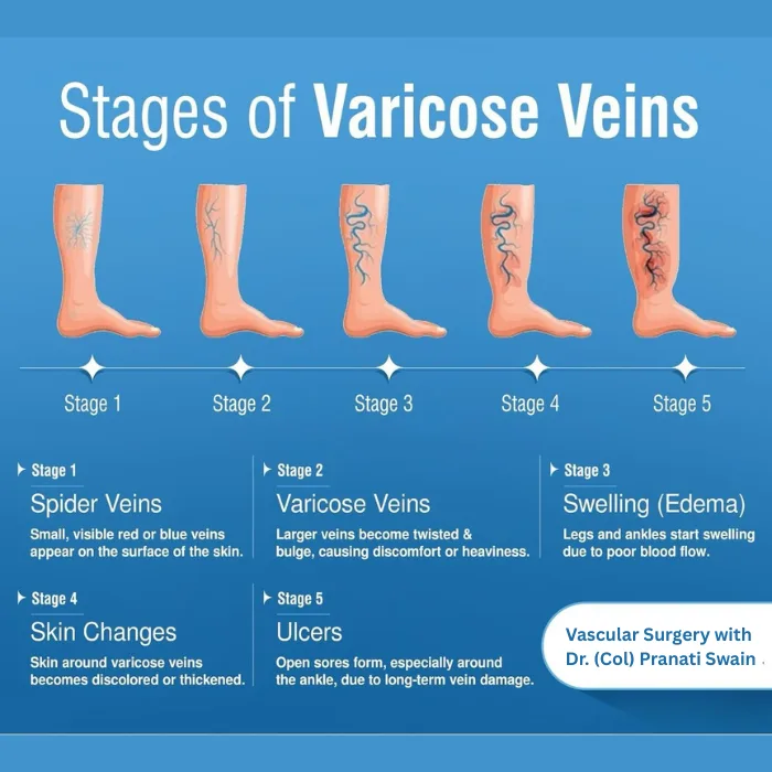Chart of the five stages of varicose veins, from spider veins through swelling to open ulcers