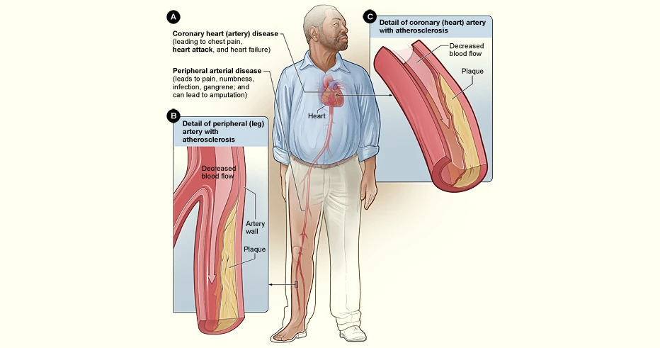 Illustration of atherosclerosis narrowing a leg artery in peripheral arterial disease, with a detail of plaque inside the artery wall