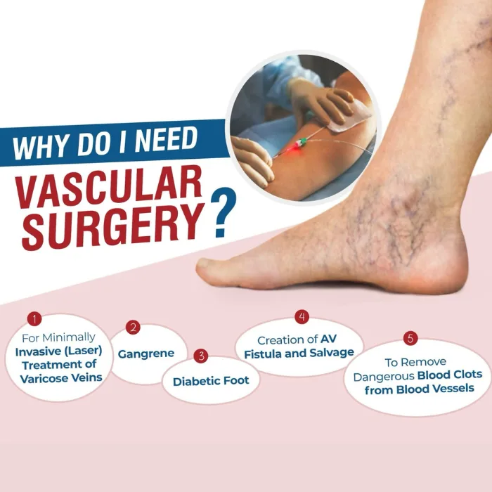 Diagram of reasons to see a vascular surgeon: varicose veins, gangrene, diabetic foot and AV fistula